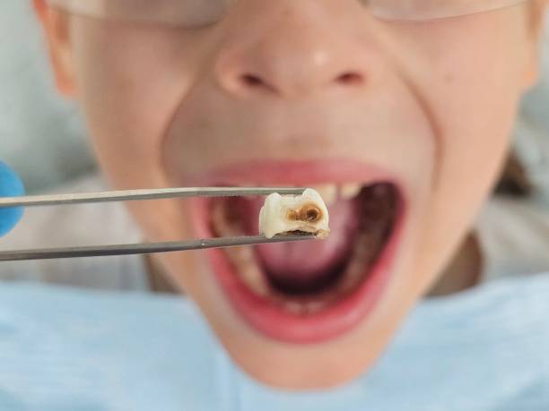 Best Emergency Treatment for Toothache in Centreville, AL